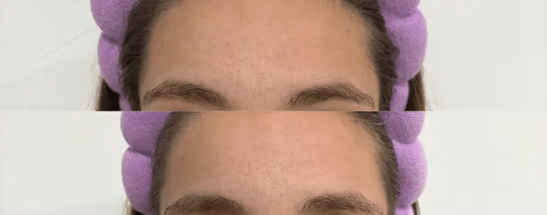 Nua Silicone Patch – Forehead