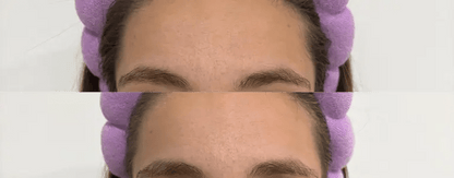 Nua Silicone Patch – Forehead